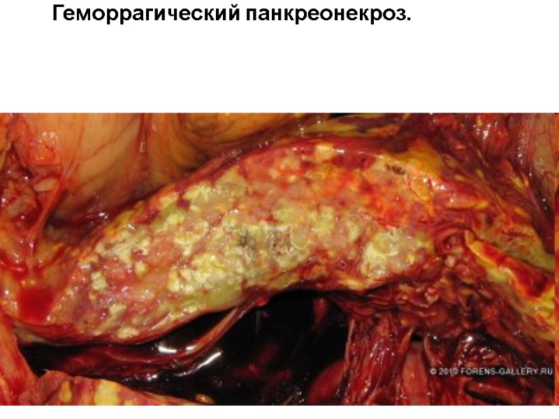 Геморрагический панкреонекроз.